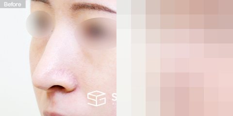 슈가성형외과 재) 재수술 + 무보형물 + 긴코 + 휜코 + 매부리 + 절골 + 기증늑 + 귀연골 + 귀 뒤 근막 + 비중격만곡증 전후사진 - 정면 수술 전후 비교