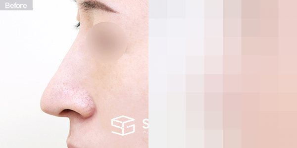 슈가성형외과 재) 재수술 + 무보형물 + 긴코 + 휜코 + 매부리 + 절골 + 기증늑 + 귀연골 + 귀 뒤 근막 + 비중격만곡증 전후사진 - 45도 수술 전후 비교