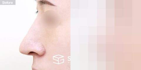 슈가성형외과 재) 재수술 + 무보형물 + 긴코 + 휜코 + 매부리 + 절골 + 기증늑 + 귀연골 + 귀 뒤 근막 + 비중격만곡증 전후사진 - 45도 수술 전후 비교