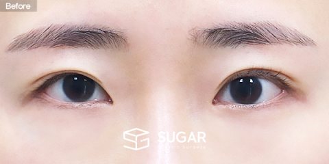 슈가성형외과 재) 재수술 + 자연유착 + 눈매교정 + 윗트임 전후사진 - 수술 전