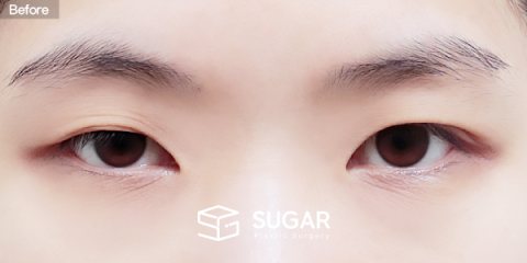 슈가성형외과 재) 재수술 + 자연유착 + 눈매교정 + 윗트임 + 뒤밑트임 전후사진 - 수술 전
