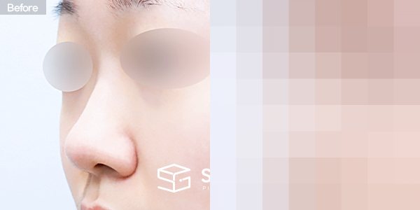 슈가성형외과 첫) 콧대 + 코끝 + 복코 + 콧볼축소 + 귀연골 전후사진 - 정면 수술 전후 비교