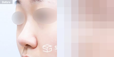 슈가성형외과 첫) 콧대 + 코끝 + 복코 + 콧볼축소 + 귀연골 전후사진 - 정면 수술 전후 비교