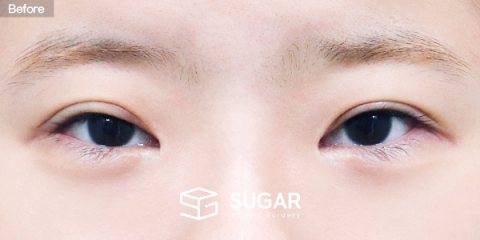 슈가성형외과 재) 재수술 + 절개 + 눈매교정 + 뒤밑트임 전후사진 - 수술 전