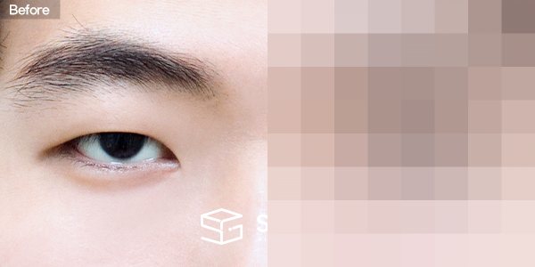 슈가성형외과 첫) 절개 + 눈매교정 + 앞트임 전후사진 - 정면 수술 전후 비교