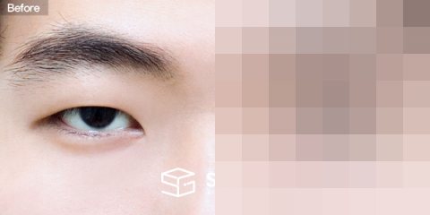 슈가성형외과 첫) 절개 + 눈매교정 + 앞트임 전후사진 - 정면 수술 전후 비교