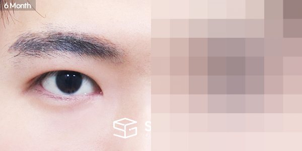 슈가성형외과 첫) 절개 + 눈매교정 + 앞트임 전후사진 - 45도 수술 전후 비교