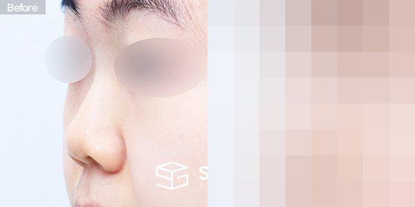 슈가성형외과 첫) 콧대 + 코끝 + 귀연골 + 복코 + 짧은코 + 매부리 전후사진 - 정면 수술 전후 비교