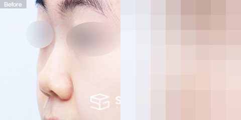 슈가성형외과 첫) 콧대 + 코끝 + 귀연골 + 복코 + 짧은코 + 매부리 전후사진 - 정면 수술 전후 비교