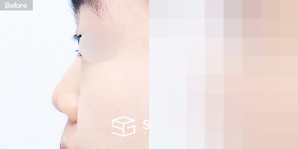 슈가성형외과 첫) 콧대 + 코끝 + 귀연골 + 복코 + 짧은코 + 매부리 전후사진 - 45도 수술 전후 비교