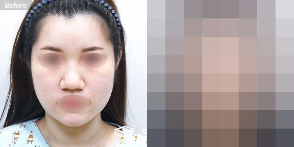 슈가성형외과 첫) 볼,이중턱 지방흡입 + 실리프팅 전후사진 - 정면 수술 전후 비교