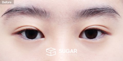 슈가성형외과 첫) 윗트임 + 뒤밑트임 전후사진 - 수술 전