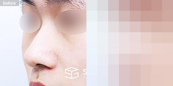 슈가성형외과 첫) 콧대 + 코끝 + 비중격연골 + 귀연골 + 매부리 + 복코 전후사진 - 정면 수술 전후 비교