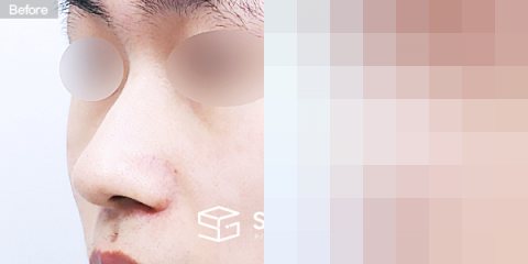 슈가성형외과 첫) 콧대 + 코끝 + 비중격연골 + 귀연골 + 매부리 + 복코 전후사진 - 정면 수술 전후 비교