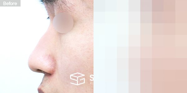 슈가성형외과 첫) 콧대 + 코끝 + 비중격연골 + 귀연골 + 매부리 + 복코 전후사진 - 45도 수술 전후 비교