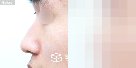 슈가성형외과 첫) 콧대 + 코끝 + 비중격연골 + 귀연골 + 매부리 + 복코 전후사진 - 45도 수술 전후 비교