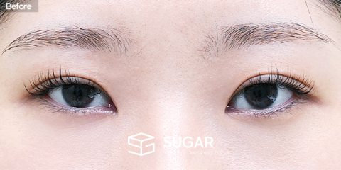 슈가성형외과 첫) 뒤밑트임 전후사진 - 수술 전