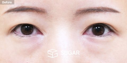 슈가성형외과 첫) 눈밑지방재배치 전후사진 - 수술 전