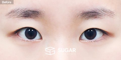 슈가성형외과 첫) 자연유착 + 눈매교정 + 앞트임 전후사진 - 수술 전