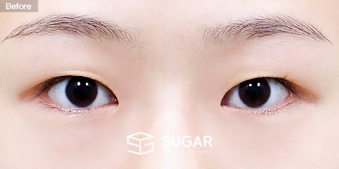슈가성형외과 첫) 자연유착 + 눈매교정 전후사진 - 수술 전