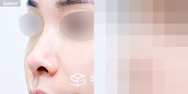 슈가성형외과 첫) 콧대 + 코끝 + 비중격연골 + 귀연골 + 복코 + 비공내리기 전후사진 - 정면 수술 전후 비교