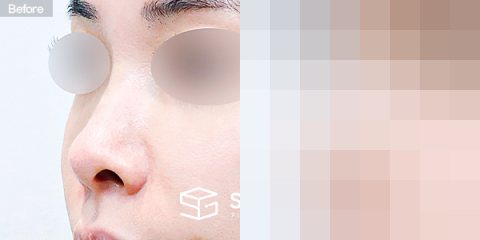 슈가성형외과 첫) 콧대 + 코끝 + 비중격연골 + 귀연골 + 복코 + 비공내리기 전후사진 - 정면 수술 전후 비교