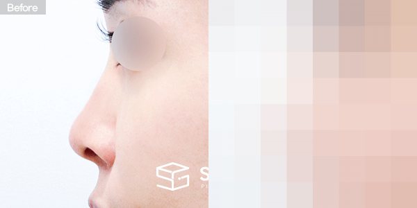 슈가성형외과 첫) 콧대 + 코끝 + 비중격연골 + 귀연골 + 복코 + 비공내리기 전후사진 - 45도 수술 전후 비교
