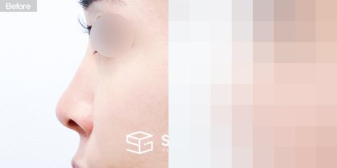 슈가성형외과 첫) 콧대 + 코끝 + 비중격연골 + 귀연골 + 복코 + 비공내리기 전후사진 - 45도 수술 전후 비교
