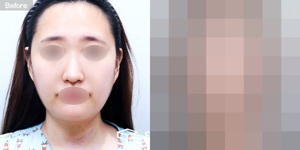 슈가성형외과 첫) 풀페이스 지방이식 전후사진 - 정면 수술 전후 비교