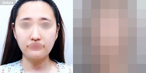 슈가성형외과 첫) 풀페이스 지방이식 전후사진 - 정면 수술 전후 비교