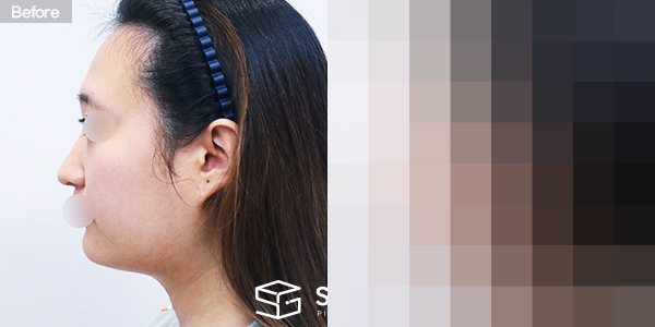 슈가성형외과 첫) 풀페이스 지방이식 전후사진 - 45도 수술 전후 비교