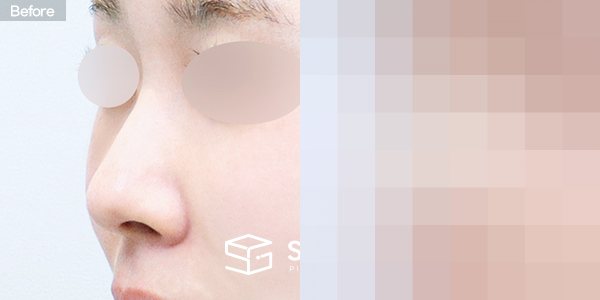 슈가성형외과 첫) 콧대 + 코끝 + 무보형물 + 비중격연골 + 귀연골 + 매부리 + 복코+ 휜코 + 귀 뒤 근막 전후사진 - 정면 수술 전후 비교