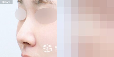 슈가성형외과 첫) 콧대 + 코끝 + 무보형물 + 비중격연골 + 귀연골 + 매부리 + 복코+ 휜코 + 귀 뒤 근막 전후사진 - 정면 수술 전후 비교