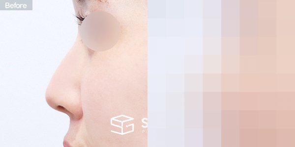 슈가성형외과 첫) 콧대 + 코끝 + 무보형물 + 비중격연골 + 귀연골 + 매부리 + 복코+ 휜코 + 귀 뒤 근막 전후사진 - 45도 수술 전후 비교