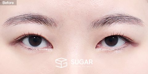 슈가성형외과 재) 재수술 + 절개 전후사진 - 수술 전