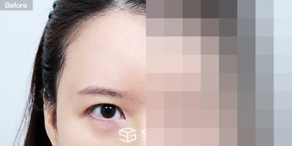 슈가성형외과 재) 자연유착 재수술 + 이마거상 전후사진 - 정면 수술 전후 비교