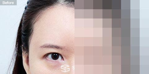 슈가성형외과 재) 자연유착 재수술 + 이마거상 전후사진 - 정면 수술 전후 비교