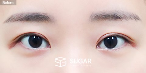 슈가성형외과 재) 재수술 + 절개 + 눈매교정 + 뒤밑트임 전후사진 - 수술 전