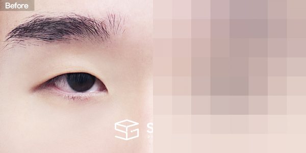 슈가성형외과 첫) 자연유착 + 눈매교정 + 윗트임 + 앞트임 + 뒤밑트임 전후사진 - 정면 수술 전후 비교
