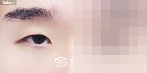 슈가성형외과 첫) 자연유착 + 눈매교정 + 윗트임 + 앞트임 + 뒤밑트임 전후사진 - 정면 수술 전후 비교