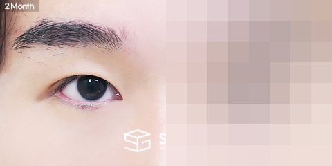 슈가성형외과 첫) 자연유착 + 눈매교정 + 윗트임 + 앞트임 + 뒤밑트임 전후사진 - 45도 수술 전후 비교