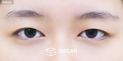 슈가성형외과 첫) 자연유착 + 눈매교정 전후사진 - 수술 전