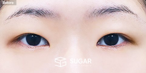 슈가성형외과 첫) 자연유착 + 눈매교정 + 윗트임 + 앞트임 + 뒤밑트임 전후사진 - 수술 전