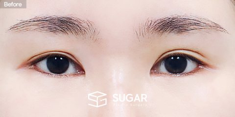 슈가성형외과 재) 재수술 + 절개 + 눈매교정 + 밑트임 전후사진 - 수술 전