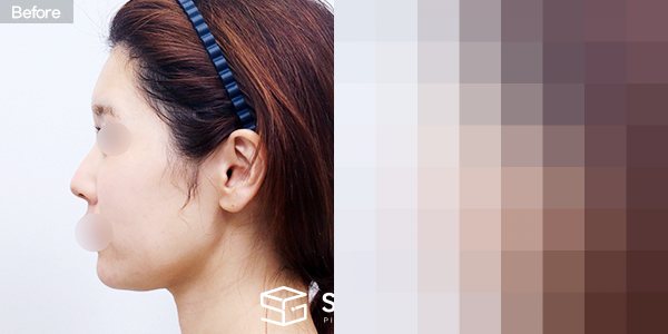 슈가성형외과 첫) 실리프팅 전후사진 - 45도 수술 전후 비교