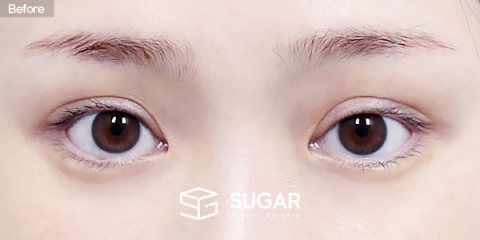 슈가성형외과 재) 재수술 + 절개 + 눈매교정 + 눈 두덩이 지방이식 전후사진 - 수술 전