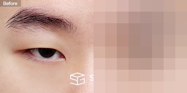 슈가성형외과 첫) 자연유착 + 눈매교정 + 앞트임 + 뒤밑트임 전후사진 - 정면 수술 전후 비교