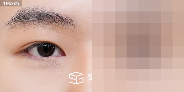 슈가성형외과 첫) 자연유착 + 눈매교정 + 앞트임 + 뒤밑트임 전후사진 - 45도 수술 전후 비교