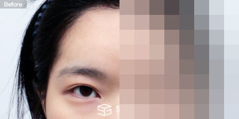 슈가성형외과 재) 절개 재수술+ 눈매교정 + 뒤밑트임 재수술 + 이마거상 전후사진 - 정면 수술 전후 비교