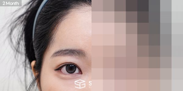 슈가성형외과 재) 절개 재수술+ 눈매교정 + 뒤밑트임 재수술 + 이마거상 전후사진 - 45도 수술 전후 비교